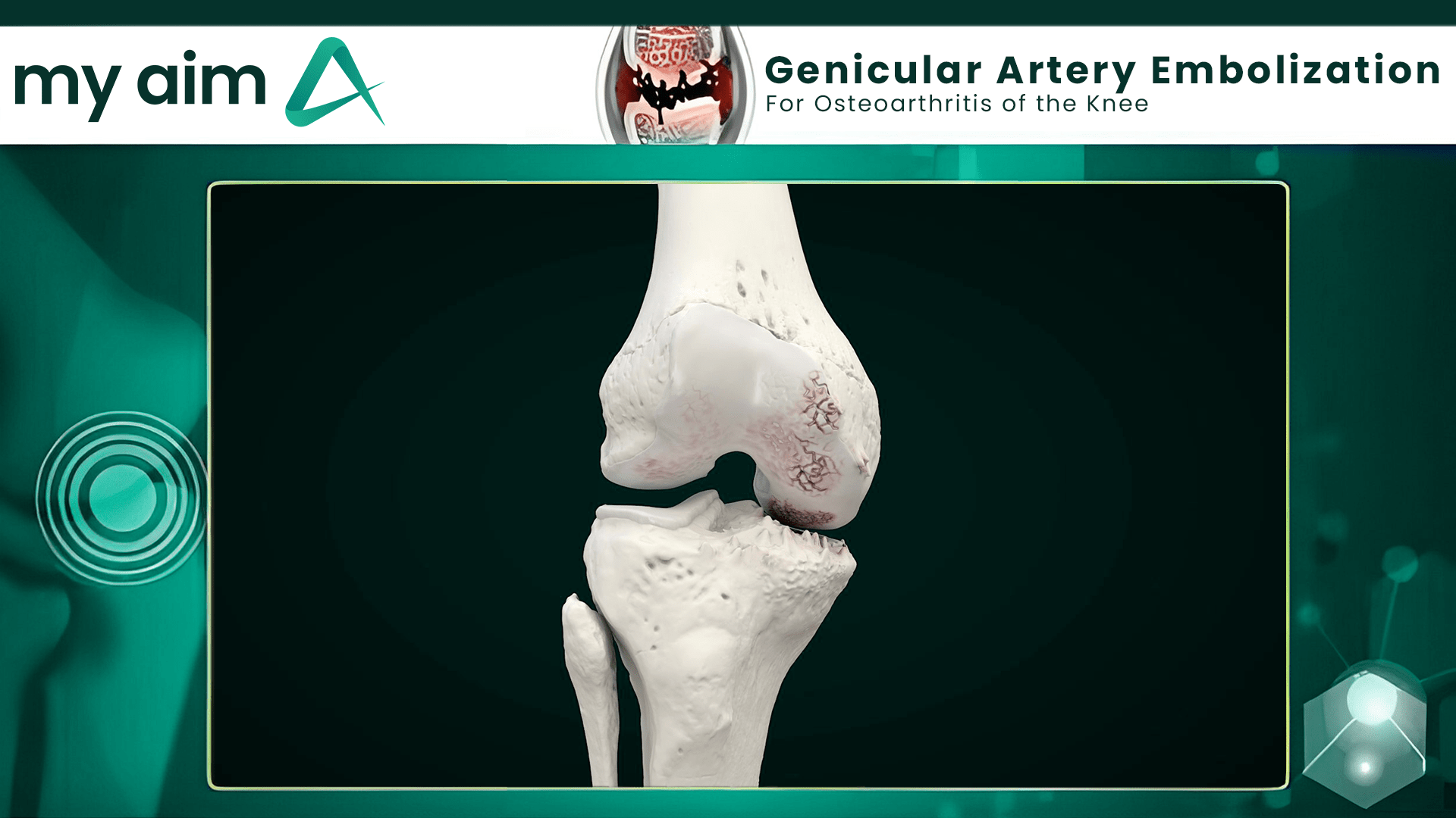 GAE Geniculate Artery Embolization AZ And Texas My Aim