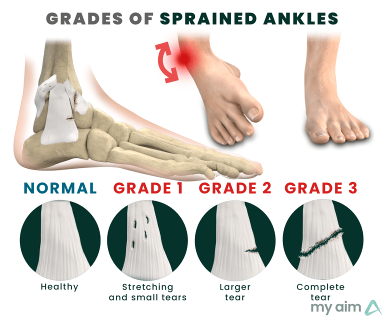 AZ Feet Fixers: Top Sprained Ankle Doctor in Mesa and Glendale - My Aim