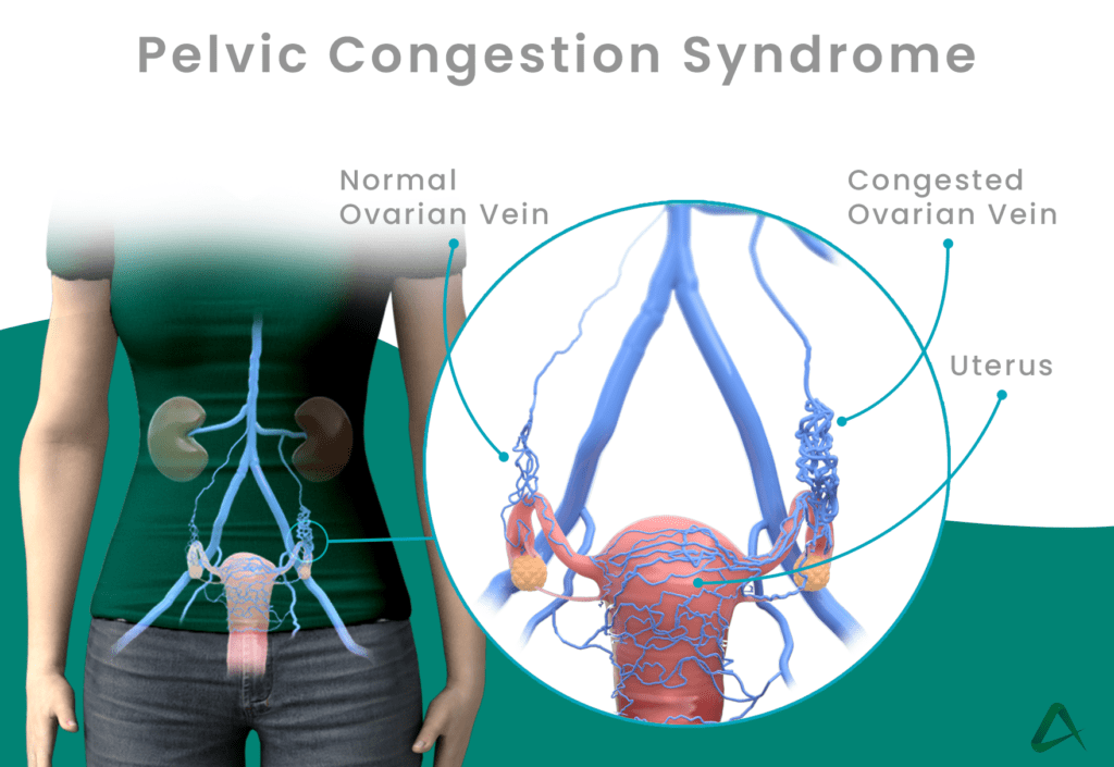 Pelvic congestion syndrome