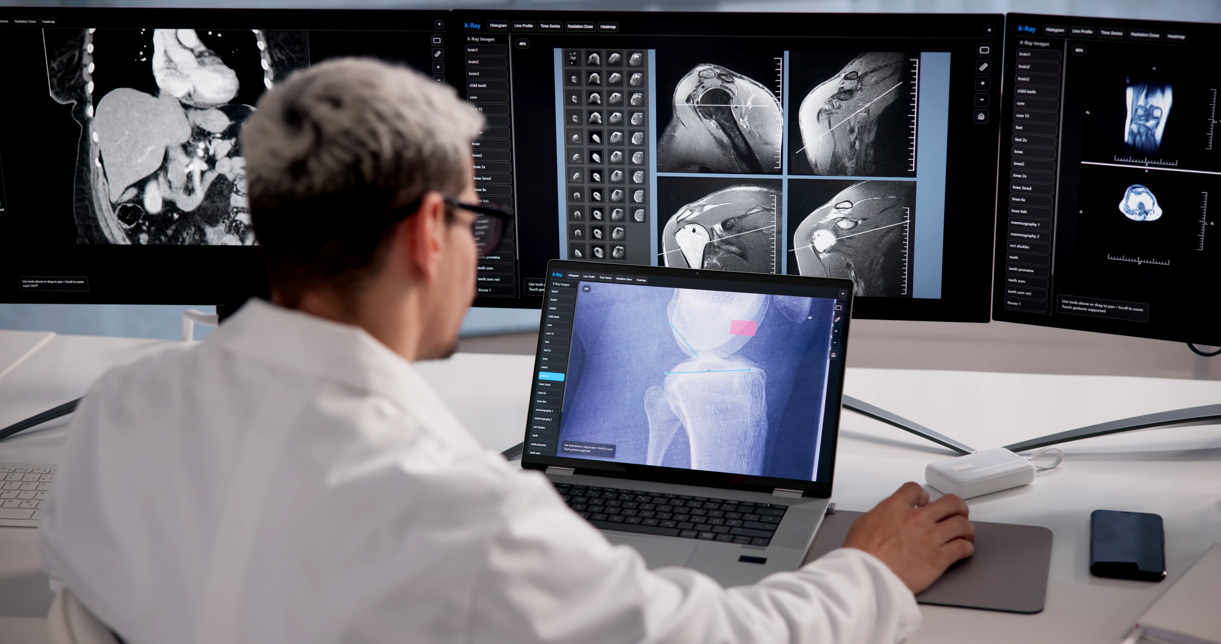 Interventional radiologist reviewing vascular imaging to diagnose leg pain