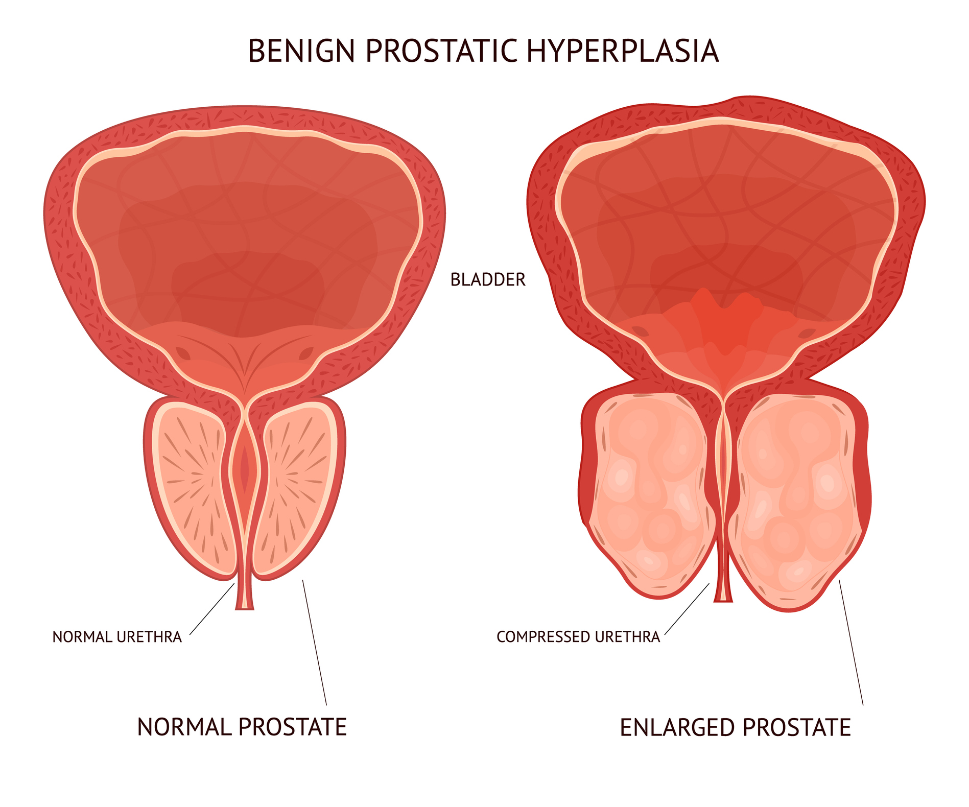 Non-surgical treatment for enlarged prostate