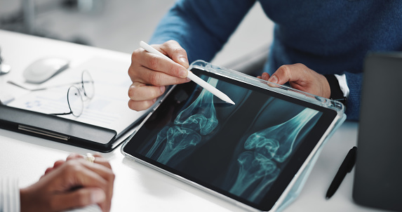 Genicular Artery Embolization: How GAE Relieves Knee Pain