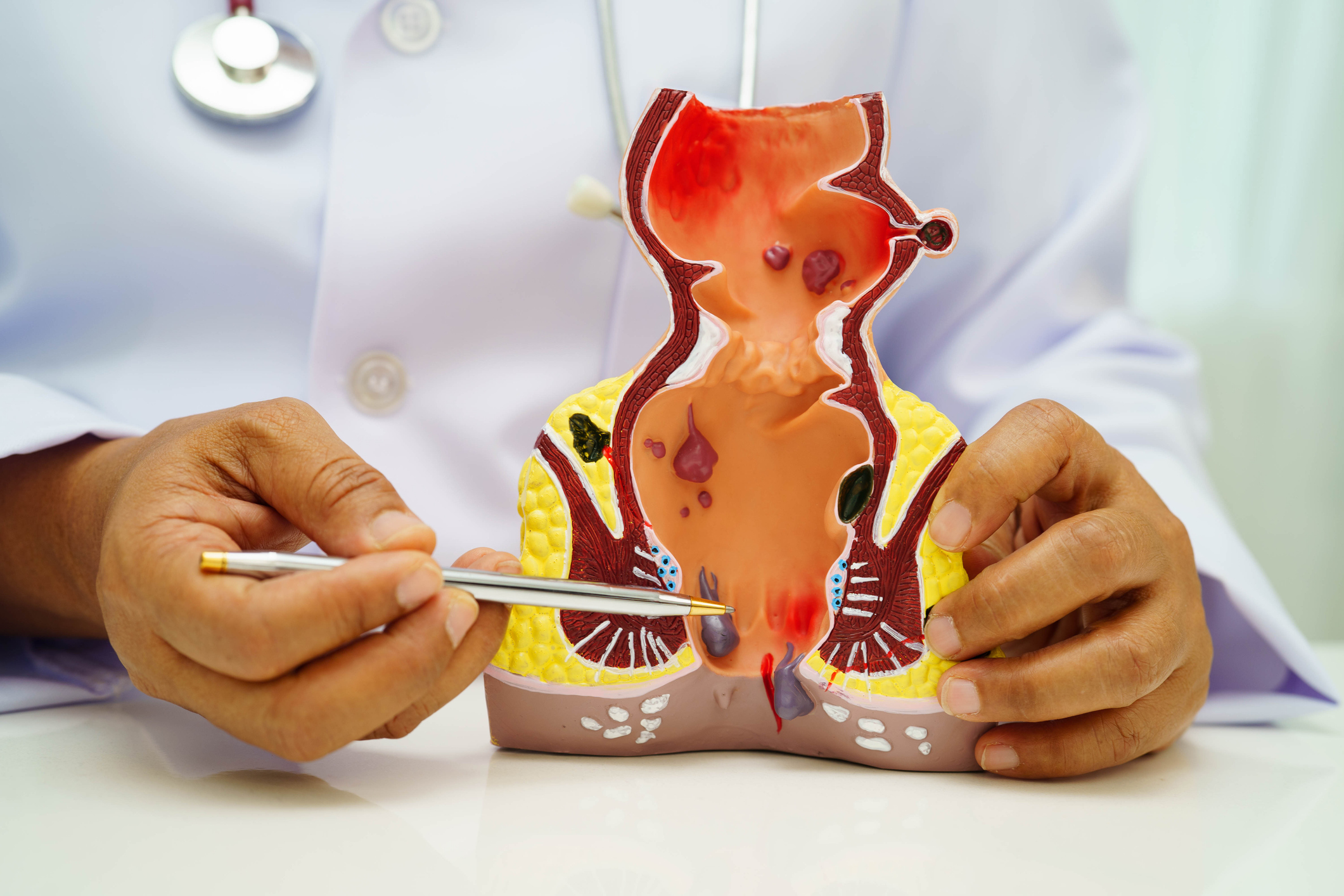 hemorrhoid treatment without surgery
